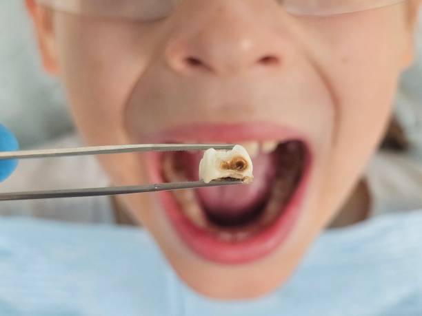 Best Dental Abscess Treatment in Franklin Farm, VA
